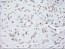 GFAP Antibody - IHC of paraffin-embedded Carcinoma of pancreas tissue using anti-GFAP mouse monoclonal antibody. (Dilution 1:50).