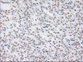 GFAP Antibody - IHC of paraffin-embedded Carcinoma of thyroid tissue using anti-GFAP mouse monoclonal antibody. (Dilution 1:50).