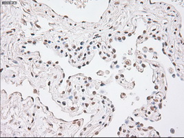GFAP Antibody - IHC of paraffin-embedded Carcinoma of lung tissue using anti-GFAP mouse monoclonal antibody. (Dilution 1:50).