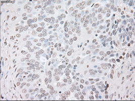 GFAP Antibody - IHC of paraffin-embedded Adenocarcinoma of ovary tissue using anti-GFAP mouse monoclonal antibody. (Dilution 1:50).