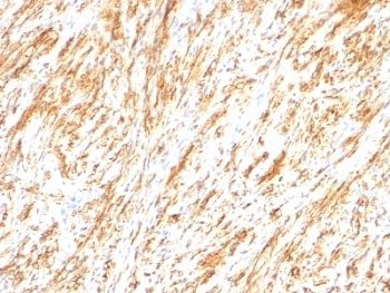 GFAP Antibody - Formalin-fixed, paraffin-embedded human Schwannoma stained with Glial Fibrillary Acidic Protein antibody (SPM248).  This image was taken for the unmodified form of this product. Other forms have not been tested.