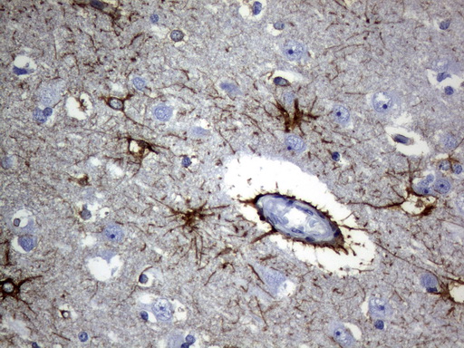 GFAP Antibody - Immunohistochemical staining of paraffin-embedded Human adult brain tissue using anti-GFAP mouse monoclonal antibody.  heat-induced epitope retrieval by 10mM citric buffer, pH6.0, 120C for 3min)