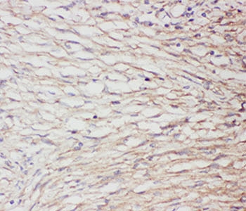 GFAP Antibody - IHC-P: GFAP antibody testing of human brain cancer