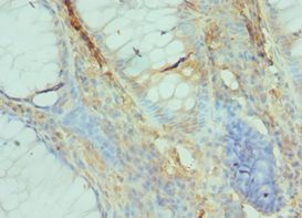 GFER Antibody - Immunohistochemistry of paraffin-embedded human colon cancer using antibody at 1:100 dilution.