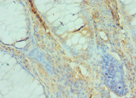 GFER Antibody - Immunohistochemistry of paraffin-embedded human colon cancer using GFER Antibody at dilution of 1:100