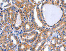 GFER Antibody - Immunohistochemistry of paraffin-embedded Human breast cancer using GFER Polyclonal Antibody at dilution of 1:50.