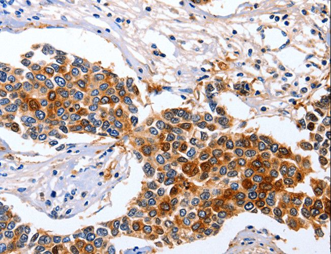 GFER Antibody - Immunohistochemistry of paraffin-embedded Human breast cancer using GFER Polyclonal Antibody at dilution of 1:50.
