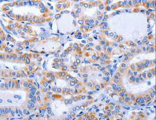 GFER Antibody - Immunohistochemistry of paraffin-embedded Human thyroid cancer using GFER Polyclonal Antibody at dilution of 1:50.