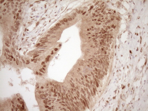 GFI1 Antibody - Immunohistochemical staining of paraffin-embedded Adenocarcinoma of Human colon tissue using anti-GFI1 mouse monoclonal antibody. (Heat-induced epitope retrieval by 1 mM EDTA in 10mM Tris, pH8.5, 120C for 3min,
