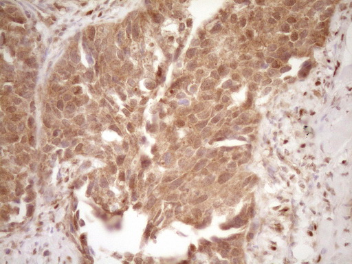 GFI1 Antibody - Immunohistochemical staining of paraffin-embedded Carcinoma of Human kidney tissue using anti-GFI1 mouse monoclonal antibody. (Heat-induced epitope retrieval by 1 mM EDTA in 10mM Tris, pH8.5, 120C for 3min,