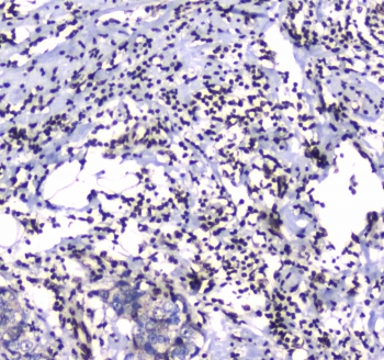 GFI1 Antibody - IHC testing of FFPE human breast cancer tissue with GFI1 antibody at 1ug/ml. Required HIER: steam section in pH6 citrate buffer for 20 min and allow to cool prior to staining.