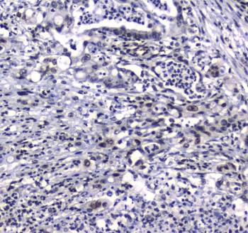 GFI1 Antibody - IHC testing of FFPE human rectal cancer tissue with GFI1 antibody at 1ug/ml. Required HIER: steam section in pH6 citrate buffer for 20 min and allow to cool prior to staining.