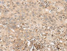 GFI1 Antibody - Immunohistochemistry of paraffin-embedded Human cervical cancer tissue  using GFI1 Polyclonal Antibody at dilution of 1:60(×200)