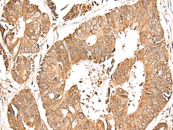 GFI1 Antibody - Immunohistochemistry of paraffin-embedded Human colorectal cancer tissue  using GFI1 Polyclonal Antibody at dilution of 1:60(×200)