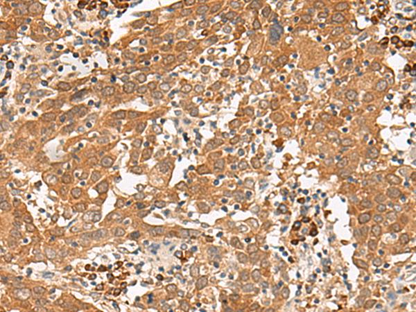 GFI1 Antibody - Immunohistochemistry of paraffin-embedded Human cervical cancer tissue  using GFI1 Polyclonal Antibody at dilution of 1:100(×200)