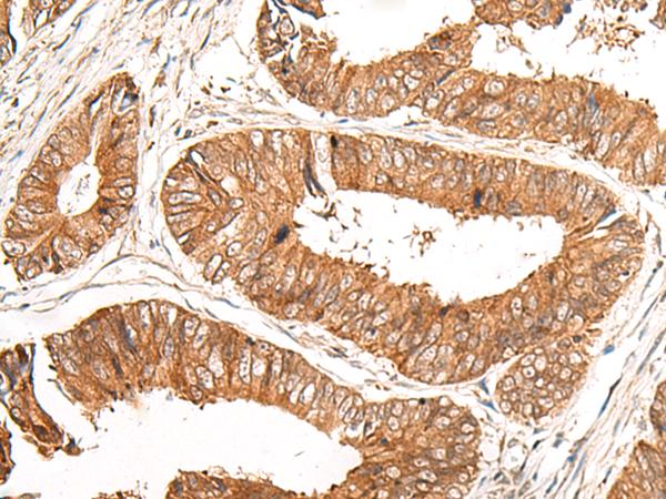 GFI1 Antibody - Immunohistochemistry of paraffin-embedded Human colorectal cancer tissue  using GFI1 Polyclonal Antibody at dilution of 1:100(×200)
