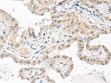 GFI1B Antibody - Immunohistochemistry of paraffin-embedded Human thyroid cancer tissue  using GFI1B Polyclonal Antibody at dilution of 1:80(×200)