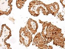 GFI1B Antibody - Immunohistochemistry of paraffin-embedded Human thyroid cancer tissue  using GFI1B Polyclonal Antibody at dilution of 1:40(×200)