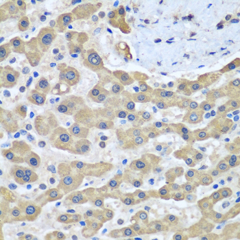 GFM1 Antibody - Immunohistochemistry of paraffin-embedded human liver cancer tissue.