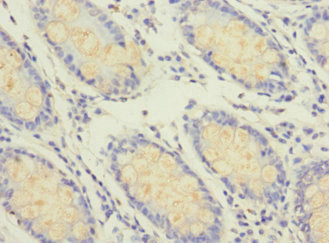GFM2 Antibody - Immunohistochemistry of paraffin-embedded human colon cancer at dilution 1:100
