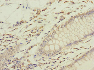 GFM2 Antibody - Immunohistochemistry of paraffin-embedded human colon cancer at dilution 1:100