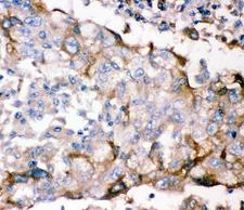 GFRA1 / GFR Alpha Antibody - IHC-P: GFRA1 antibody testing of human lung cancer tissue