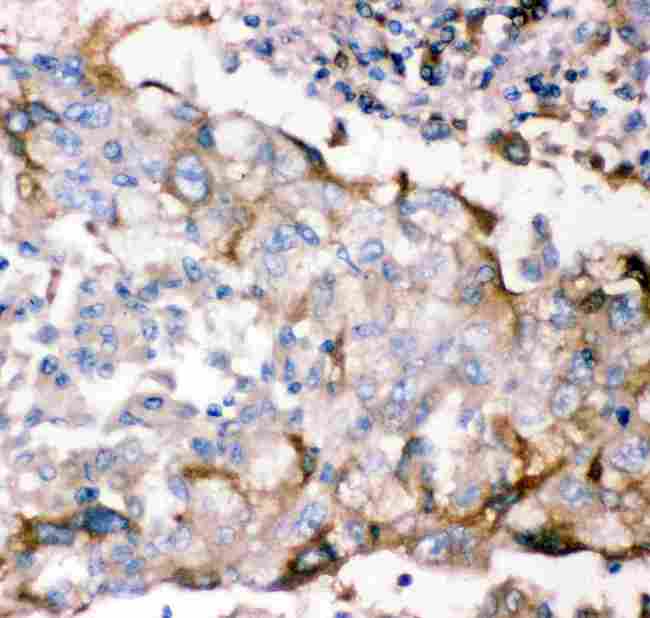GFRA1 / GFR Alpha Antibody - anti-GFRA1 antibody IHC(P): Human Lung Cancer Tissue