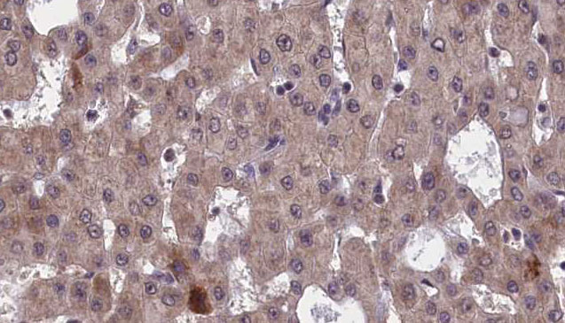 GFRA1 / GFR Alpha Antibody - 1:100 staining human liver carcinoma tissues by IHC-P. The sample was formaldehyde fixed and a heat mediated antigen retrieval step in citrate buffer was performed. The sample was then blocked and incubated with the antibody for 1.5 hours at 22°C. An HRP conjugated goat anti-rabbit antibody was used as the secondary.