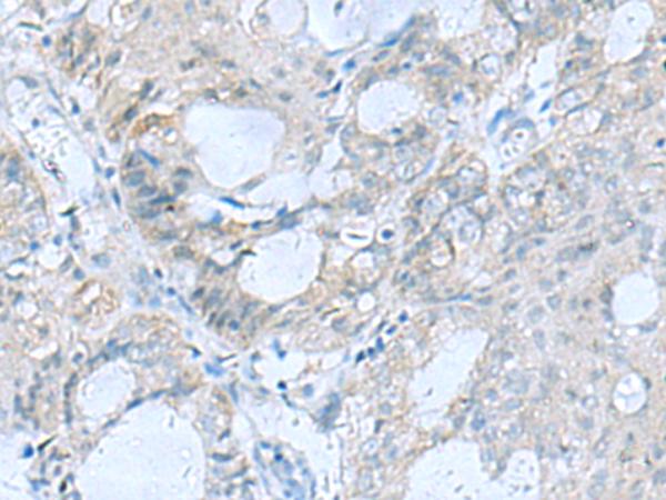 GFRA1 / GFR Alpha Antibody - Immunohistochemistry of paraffin-embedded Human ovarian cancer tissue  using GFRA1 Polyclonal Antibody at dilution of 1:65(×200)