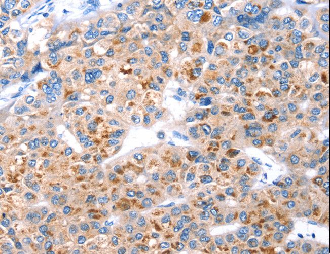 GFRA3 Antibody - Immunohistochemistry of paraffin-embedded Human liver cancer using GFRA3 Polyclonal Antibody at dilution of 1:20.