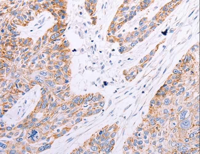 GFRA3 Antibody - Immunohistochemistry of paraffin-embedded Human esophagus cancer using GFRA3 Polyclonal Antibody at dilution of 1:60.