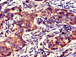 GFRAL Antibody - Immunohistochemistry of paraffin-embedded human pancreatic cancer using GFRAL Antibody at dilution of 1:100