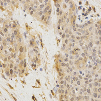 GGA2 Antibody - Immunohistochemistry of paraffin-embedded human esophageal cancer using GGA2 Antibodyat dilution of 1:200 (40x lens).