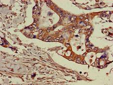 GGA3 Antibody - Immunohistochemistry of paraffin-embedded human pancreatic cancer at dilution of 1:100