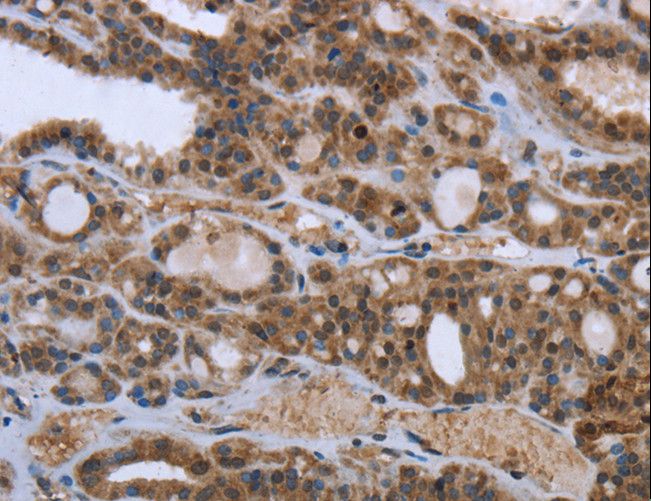 GGCX Antibody - Immunohistochemistry of paraffin-embedded Human thyroid cancer using GGCX Polyclonal Antibody at dilution of 1:50.