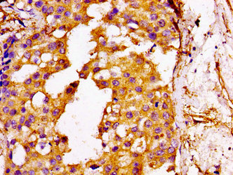 GGCX Antibody - Immunohistochemistry image at a dilution of 1:100 and staining in paraffin-embedded human breast cancer performed on a Leica BondTM system. After dewaxing and hydration, antigen retrieval was mediated by high pressure in a citrate buffer (pH 6.0) . Section was blocked with 10% normal goat serum 30min at RT. Then primary antibody (1% BSA) was incubated at 4 °C overnight. The primary is detected by a biotinylated secondary antibody and visualized using an HRP conjugated SP system.