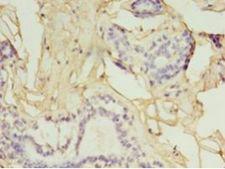 GGPS1 Antibody - Immunohistochemistry of paraffin-embedded human breast cancer using antibody at 1:100 dilution.  This image was taken for the unconjugated form of this product. Other forms have not been tested.