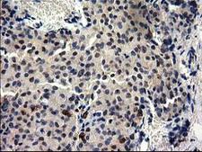 GGPS1 Antibody - Immunohistochemical staining of paraffin-embedded Adenocarcinoma of Human breast tissue using anti-GGPS1 mouse monoclonal antibody.