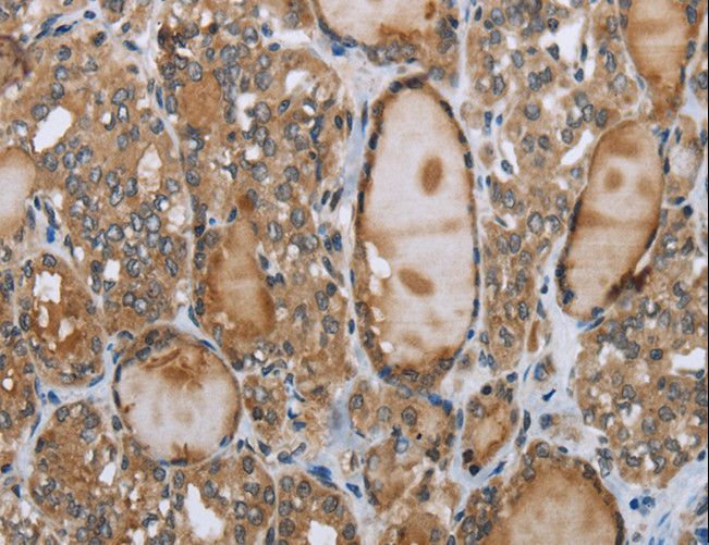 GGT1 / GGT Antibody - Immunohistochemistry of paraffin-embedded Human thyroid cancer using GGT1 Polyclonal Antibody at dilution of 1:40.