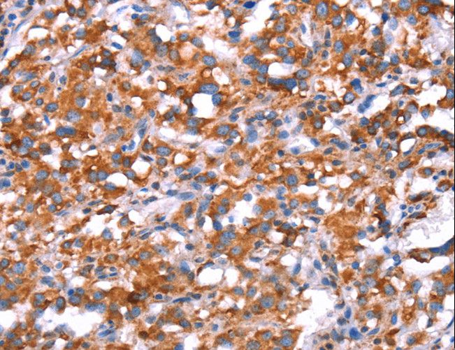GH / Growth Hormone Antibody - Immunohistochemistry of paraffin-embedded Human thyroid cancer using GH1 Polyclonal Antibody at dilution of 1:40.