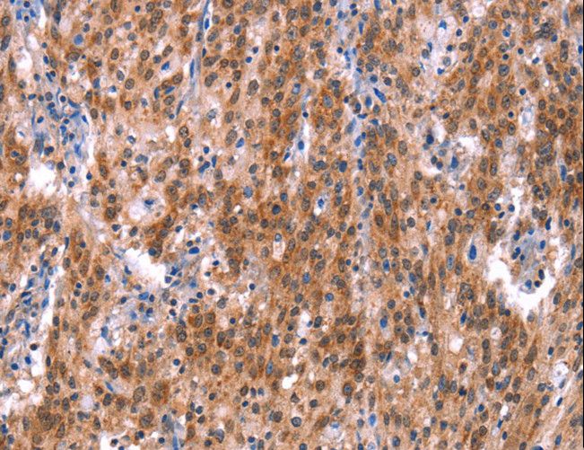 GH / Growth Hormone Antibody - Immunohistochemistry of paraffin-embedded Human gastric cancer using GH1 Polyclonal Antibody at dilution of 1:40.