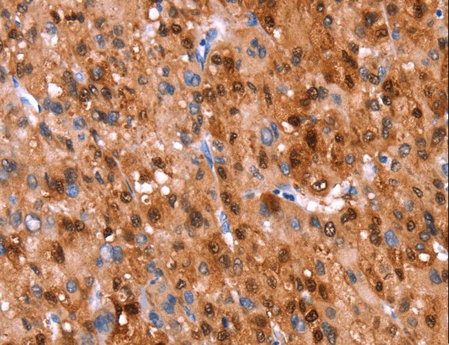 GH / Growth Hormone Antibody - Immunohistochemistry of paraffin-embedded Human liver cancer using GH1 Polyclonal Antibody at dilution of 1:40.
