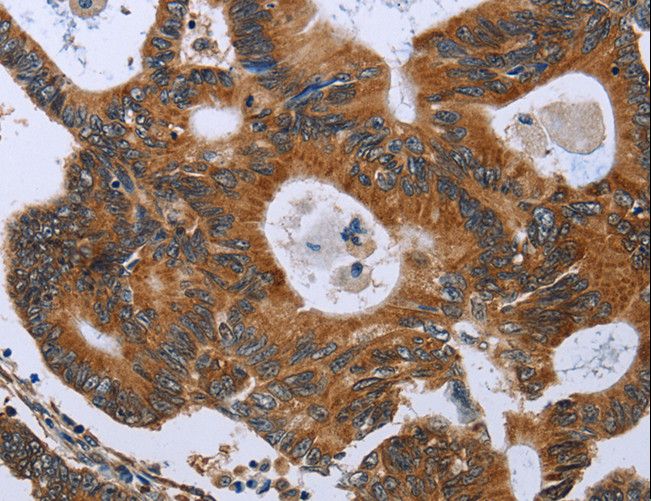 GH2 Antibody - Immunohistochemistry of paraffin-embedded Human colon cancer using GH2 Polyclonal Antibody at dilution of 1:40.