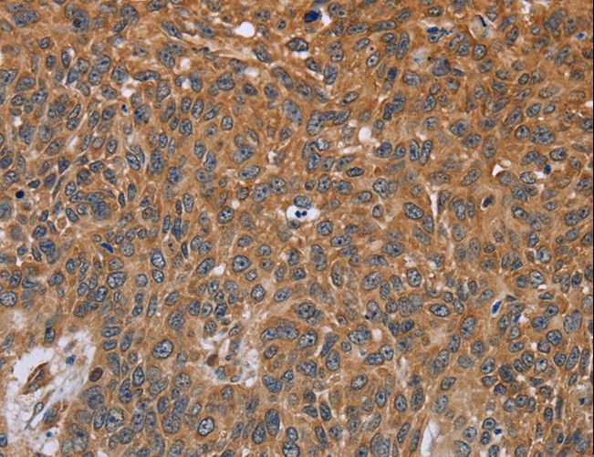 GH2 Antibody - Immunohistochemistry of paraffin-embedded Human lung cancer using GH2 Polyclonal Antibody at dilution of 1:40.