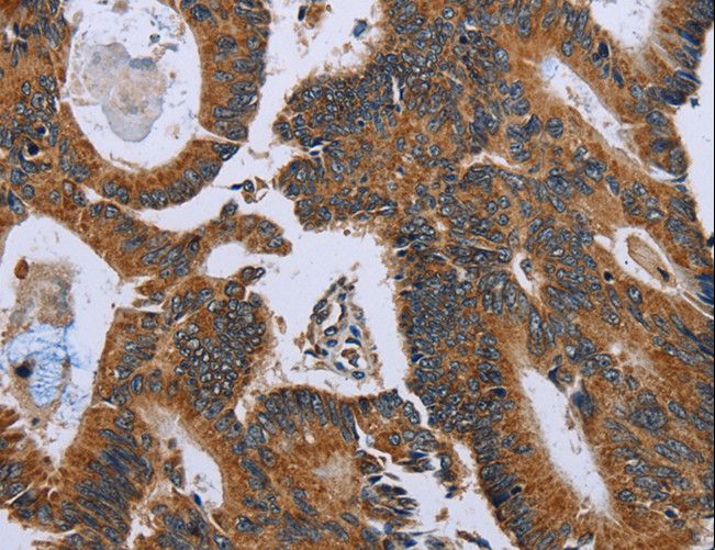 GH2 Antibody - Immunohistochemistry of paraffin-embedded Human colon cancer using GH2 Polyclonal Antibody at dilution of 1:60.