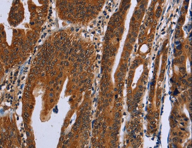 GH2 Antibody - Immunohistochemistry of paraffin-embedded Human gastric cancer using GH2 Polyclonal Antibody at dilution of 1:60.