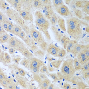 GHBP / BLVRB Antibody - Immunohistochemistry of paraffin-embedded human liver cancer tissue.