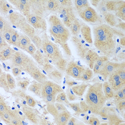 GHBP / BLVRB Antibody - Immunohistochemistry of paraffin-embedded human liver cancer tissue.