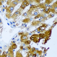 GHBP / BLVRB Antibody - Immunohistochemical analysis of BLVRB staining in human liver cancer formalin fixed paraffin embedded tissue section. The section was pre-treated using heat mediated antigen retrieval with sodium citrate buffer (pH 6.0). The section was then incubated with the antibody at room temperature and detected using an HRP conjugated compact polymer system. DAB was used as the chromogen. The section was then counterstained with hematoxylin and mounted with DPX.