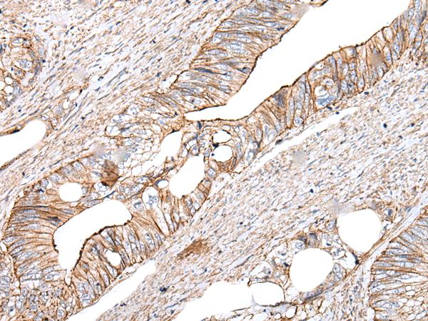 GHBP / BLVRB Antibody - Immunohistochemistry of paraffin-embedded Human colorectal cancer tissue  using BLVRB Polyclonal Antibody at dilution of 1:65(×200)